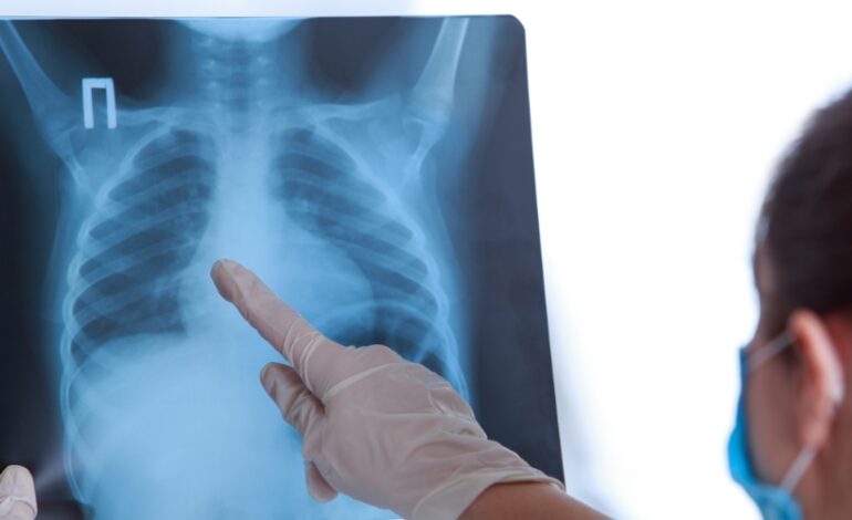La Haute autorité de santé a récemment réexaminé les stratégies de dépistage de la tuberculose pulmonaire ciblant les populations à risque. L’objectif étant à la fois de détecter rapidement les personnes atteintes mais aussi de limiter la propagation de la maladie.