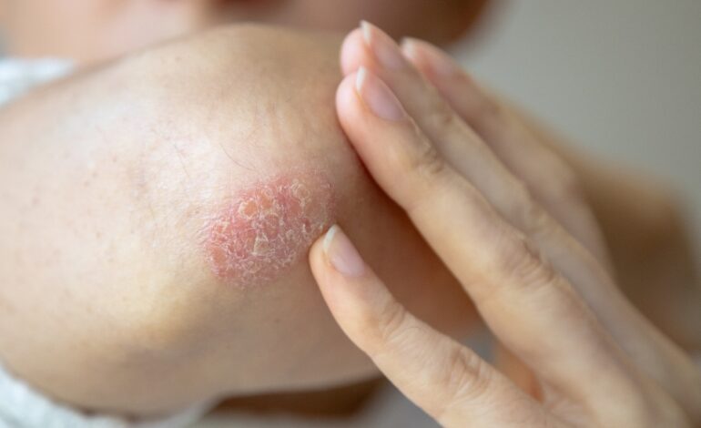 L’association France psoriasis lance une campagne pour mieux expliquer cette maladie qui ne touche pas que la peau. Chez près de 70 % de patients, en effet, elle est associée à d’autres pathologies qui méritent aussi d’être prises en charge.