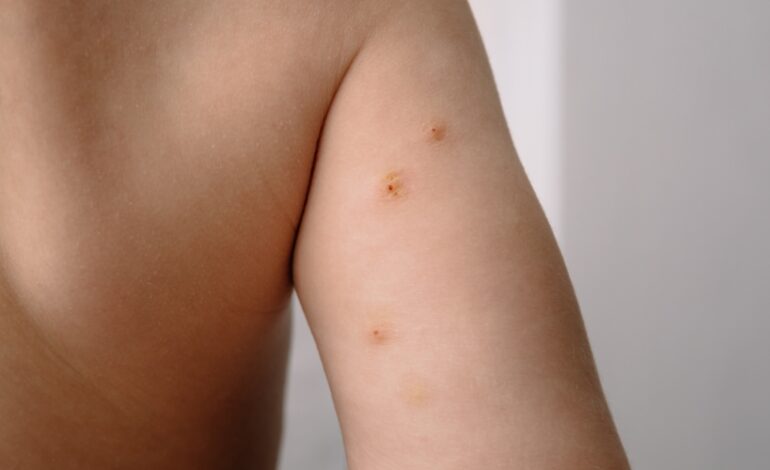 Le molluscum contagiosum est une infection cutanée fréquente chez les enfants qui, bien que contagieuse, guérit très souvent spontanément.